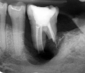 Radiografia di un dente dopo un trattamento endodontico